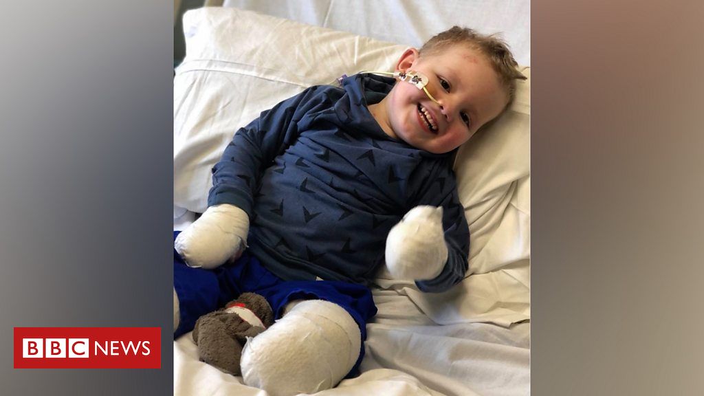 Sepsis: Boy learns to walk again after losing legs